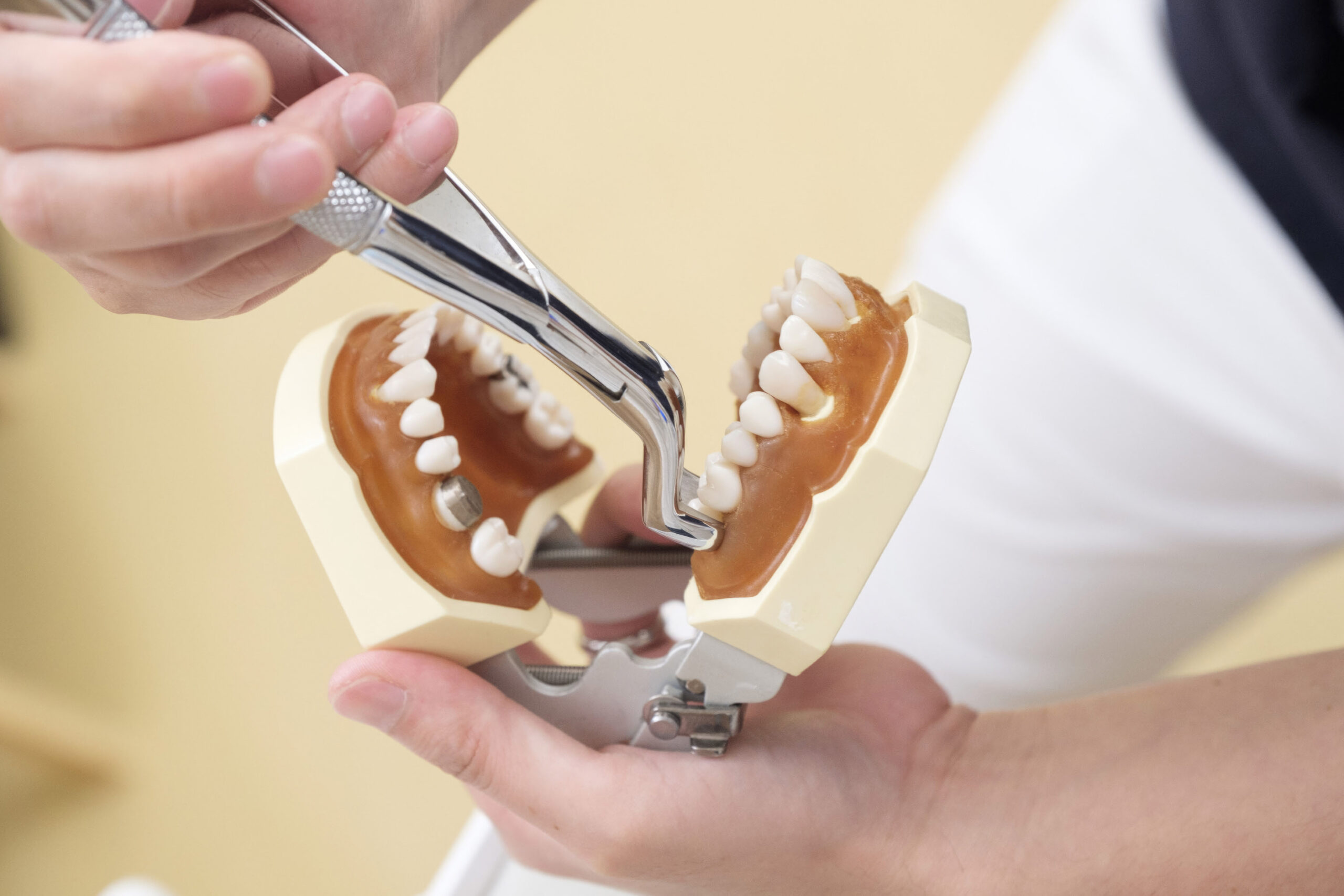 Things to Avoid After Tooth Extraction