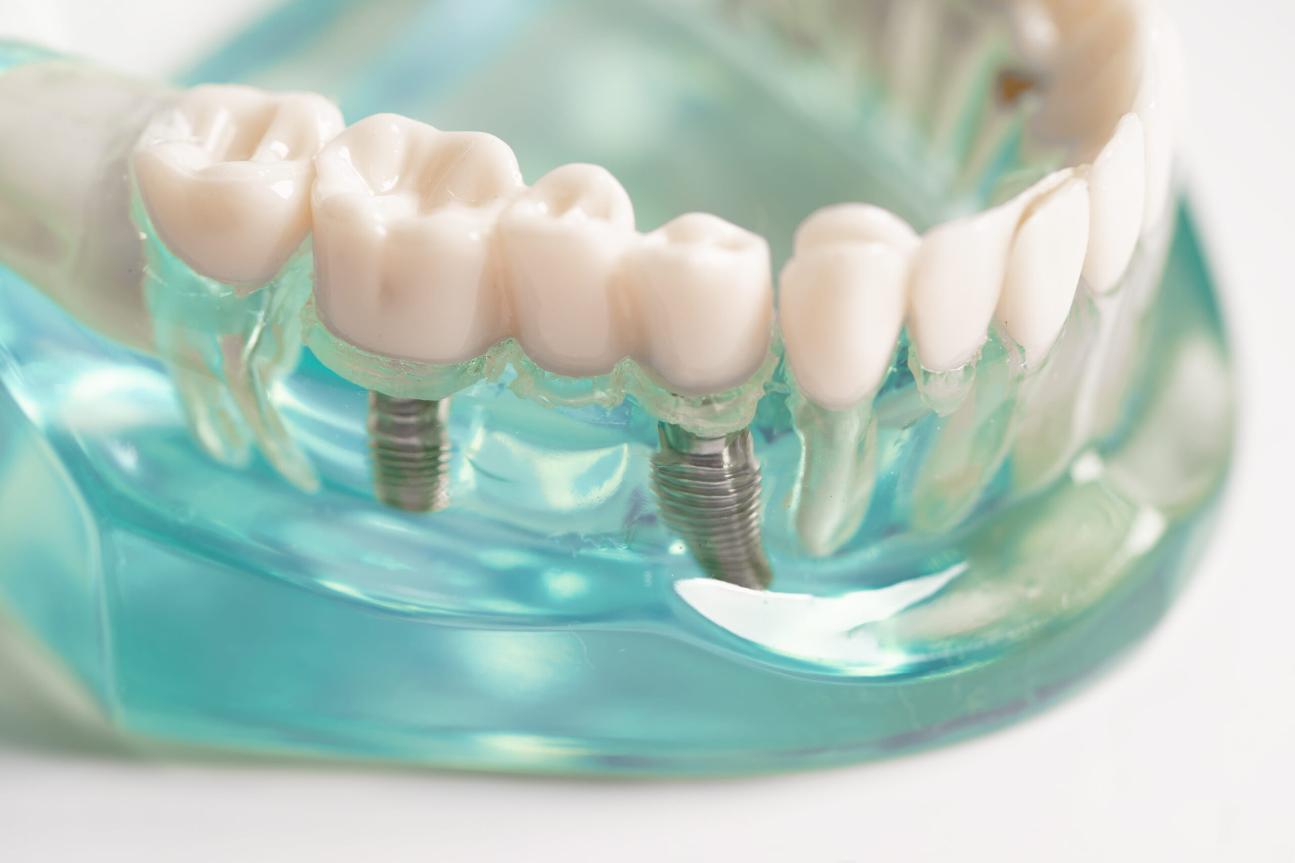 Candidate for Dental Implants