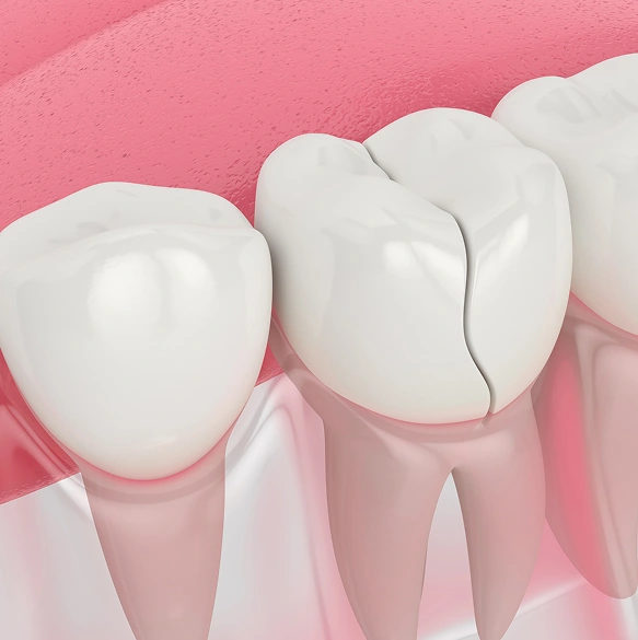 Fast, Reliable Chipped Tooth Repair