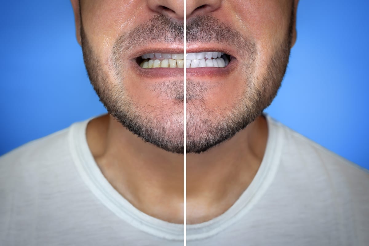 Teeth Whitening in Fort Mill